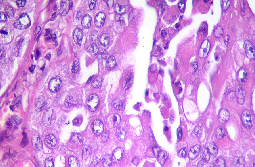 Carcinoma de Células Transicionales - CCT