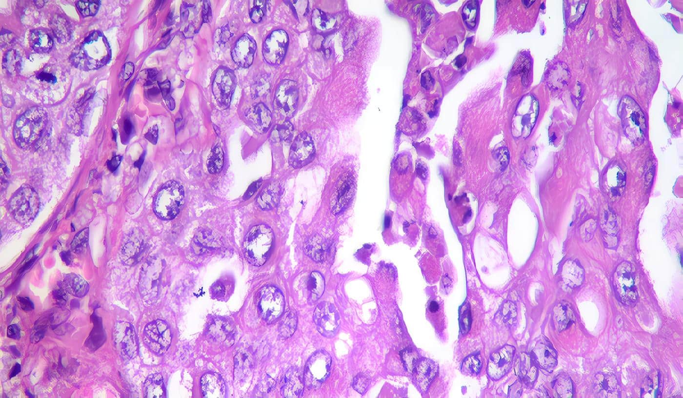 Carcinoma de Células Transicionales - CCT