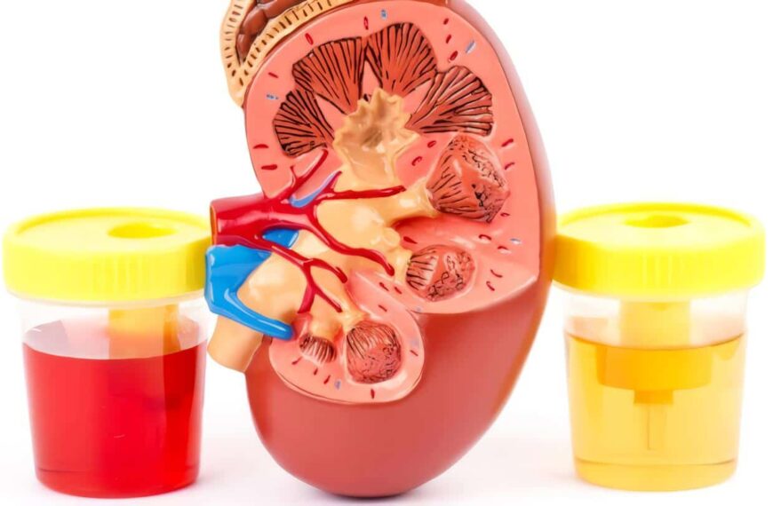 Hematuria Macroscópica