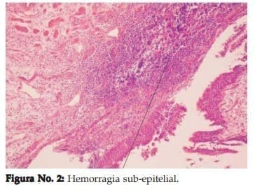 Hemorragia sub-epitelial.