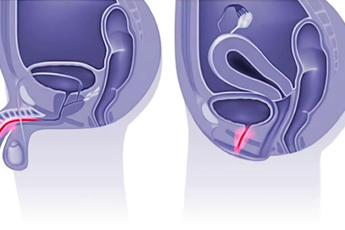 Obstrucción Ureteral