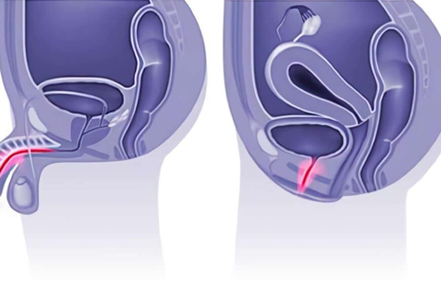 Obstrucción Ureteral