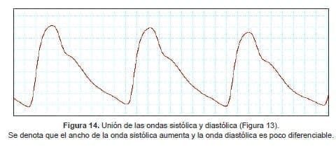 Se denota que el ancho de la onda sistólica aumenta y la onda diastólica es poco diferenciable