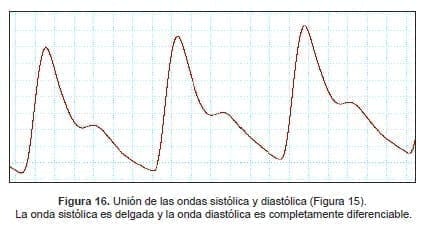 La onda sistólica es delgada y la onda diastólica es completamente diferenciable