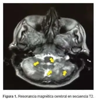 Resonancia magnética cerebral en secuencia T2