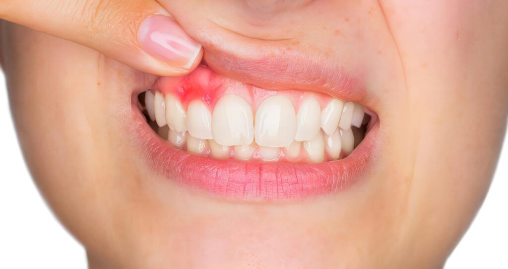 Remedios Caseros para la Gingivitis