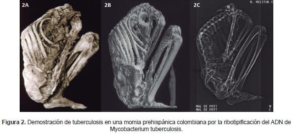 Demostración de tuberculosis en una momia prehispánica