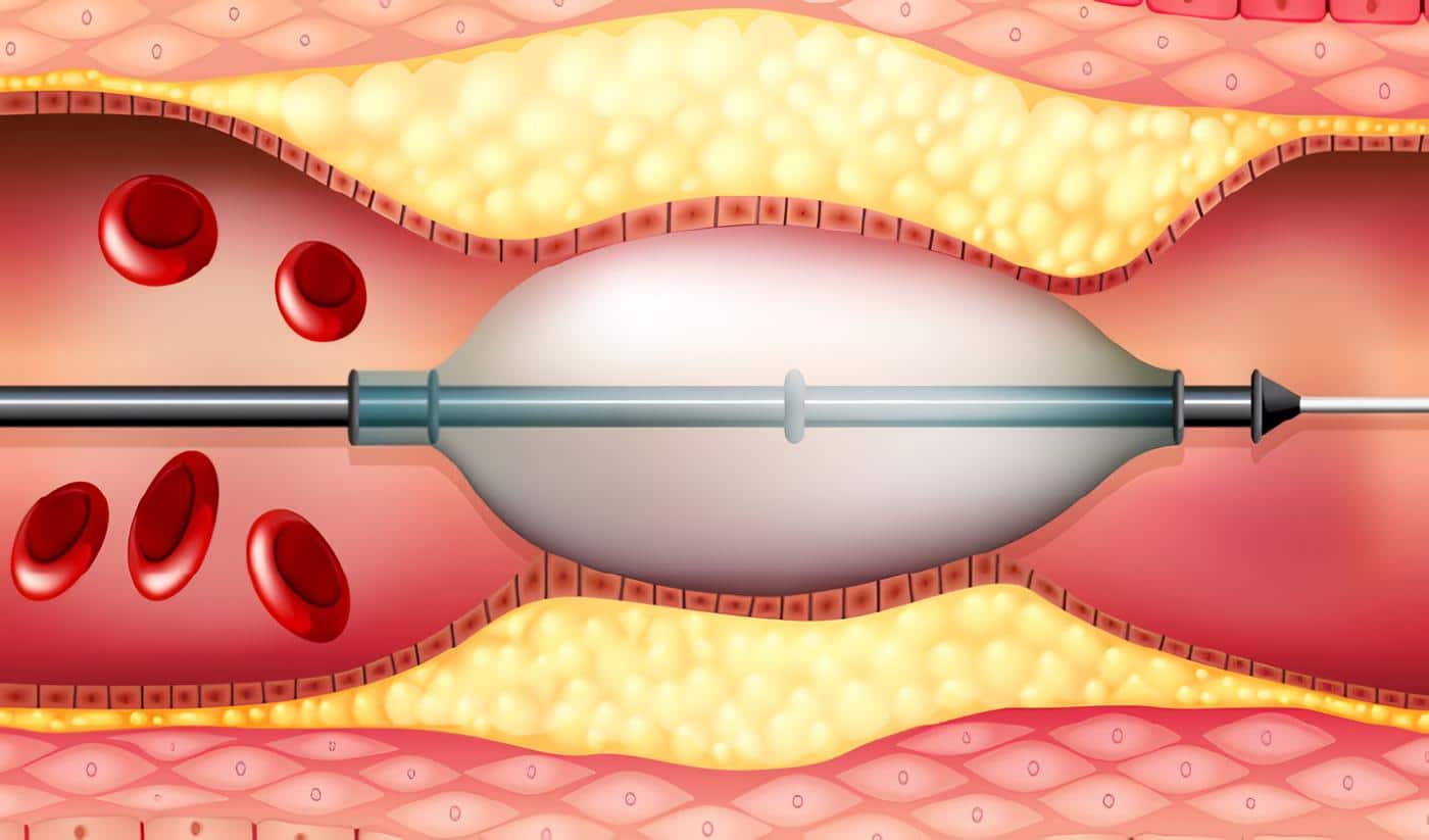 Stent Coronario Medicado