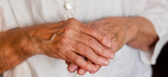 Remedios caseros para la artritis