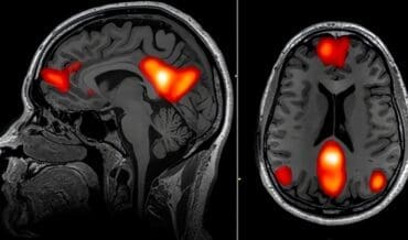Neuroimagen