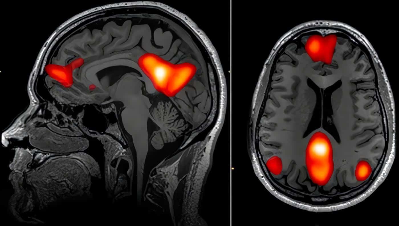 Neuroimagen