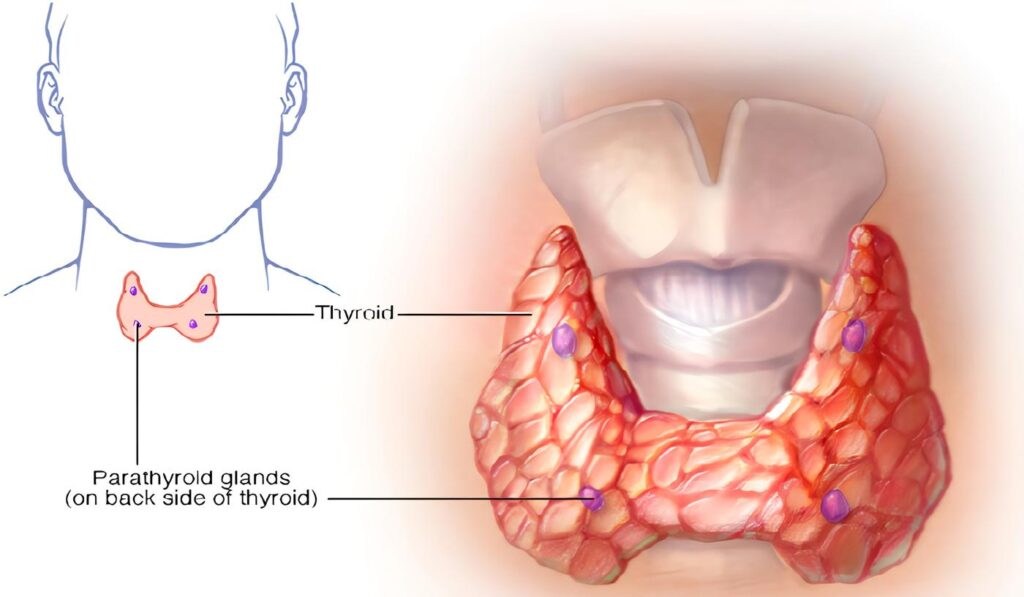 Hipercalcemia de la Malignidad