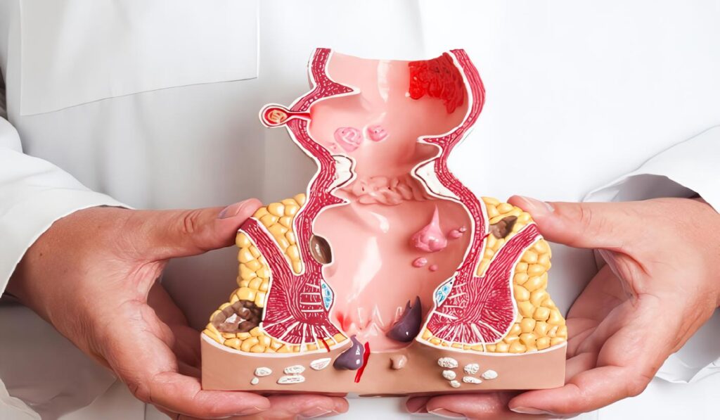 Cáncer de Ano