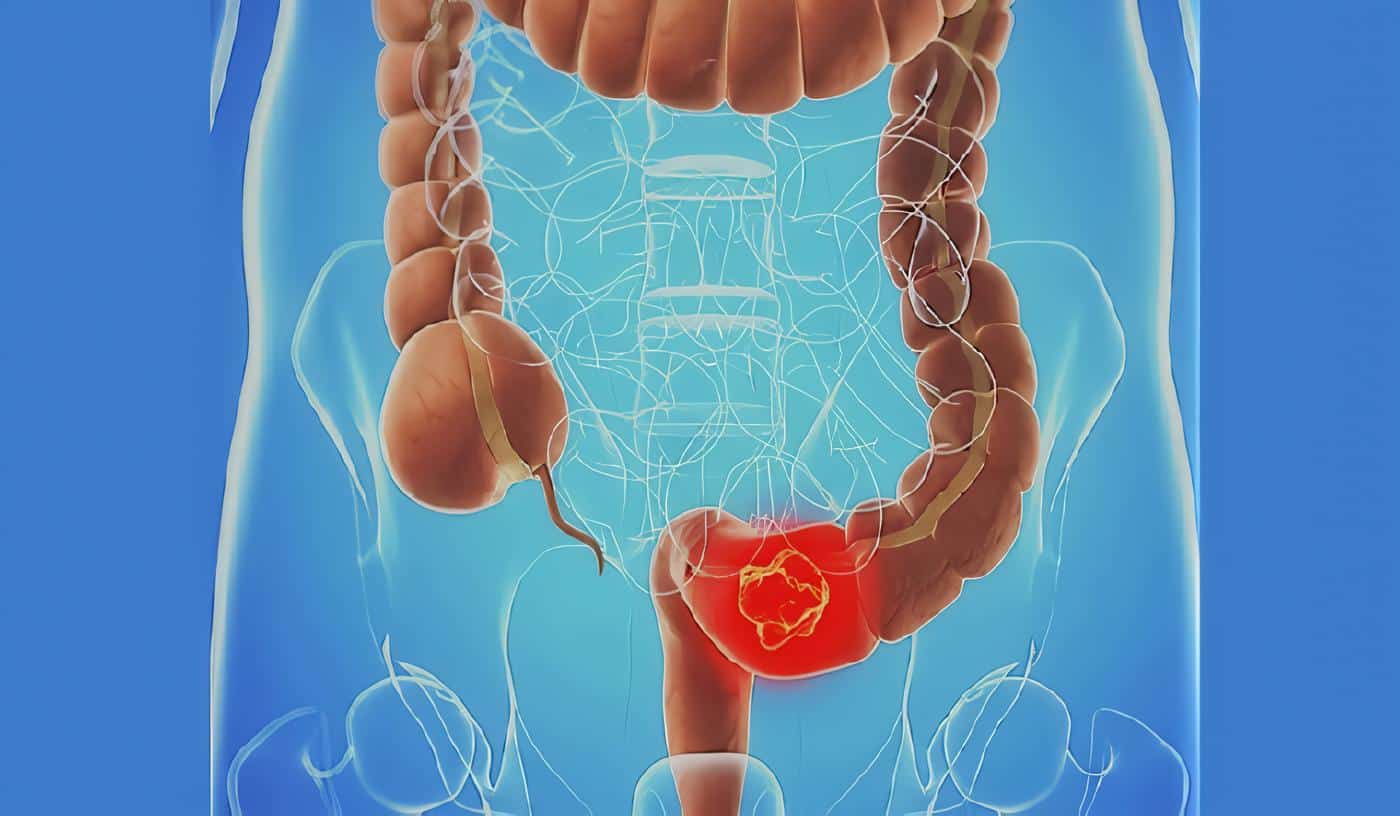 Cáncer Colo-Rectal