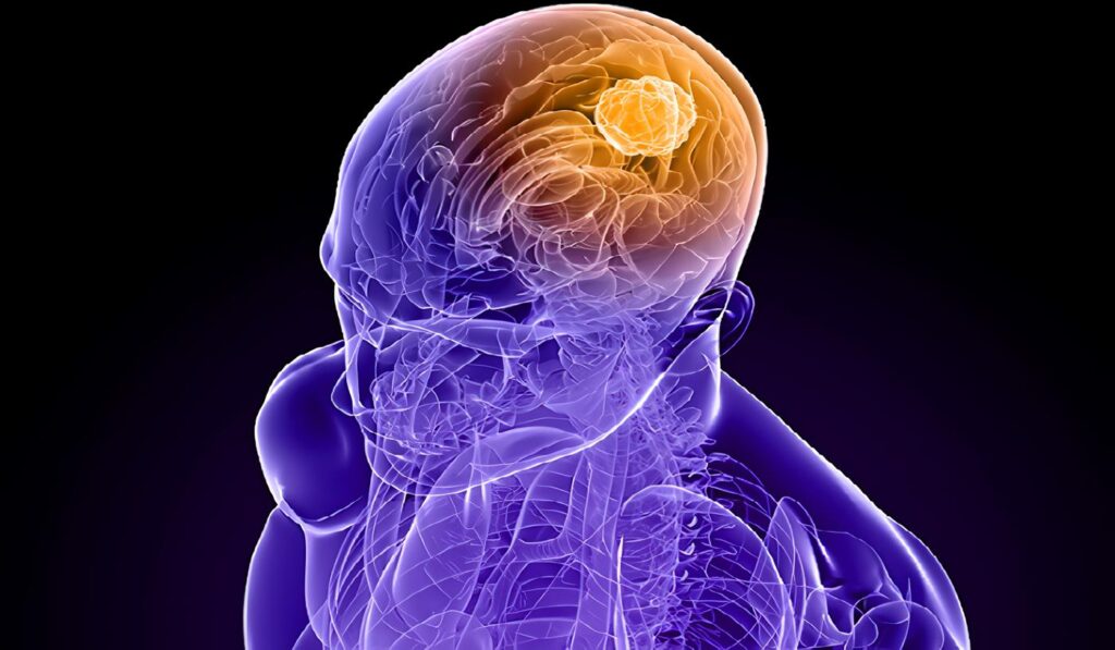 Tumores del Sistema Nervioso Central