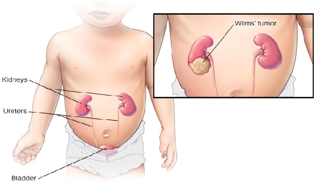 Tumor de Wilms