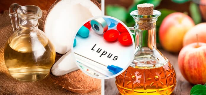 Remedios para el lupus