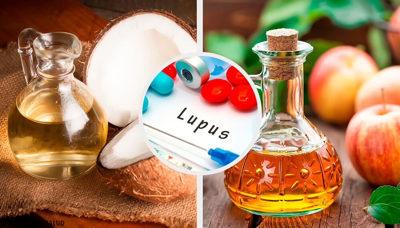 Remedios para el lupus