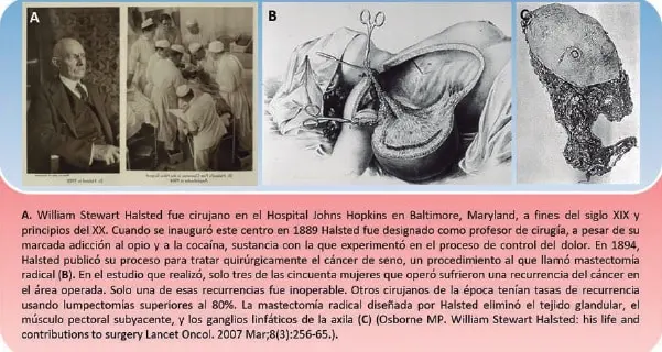 William Stewart Halsted, primera mastectomía radical