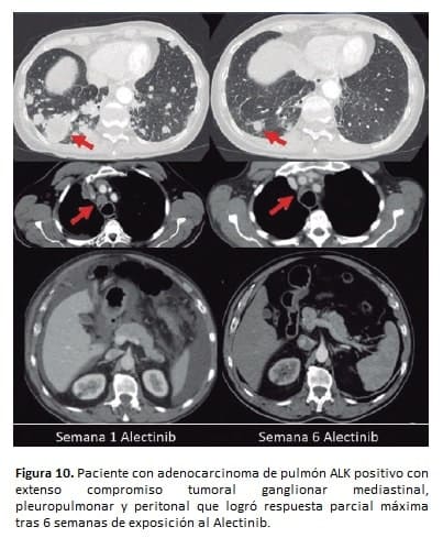 Paciente con adenocarcinoma de pulmón ALK
