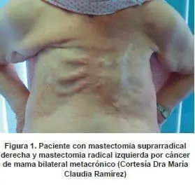 Paciente con mastectomia suprarradical derecha e izquierda por cáncer de mama bilateral metacrónico