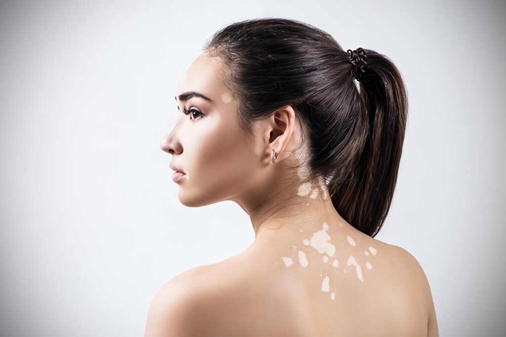 Remedios Caseros para el Vitiligo o Leucodermia