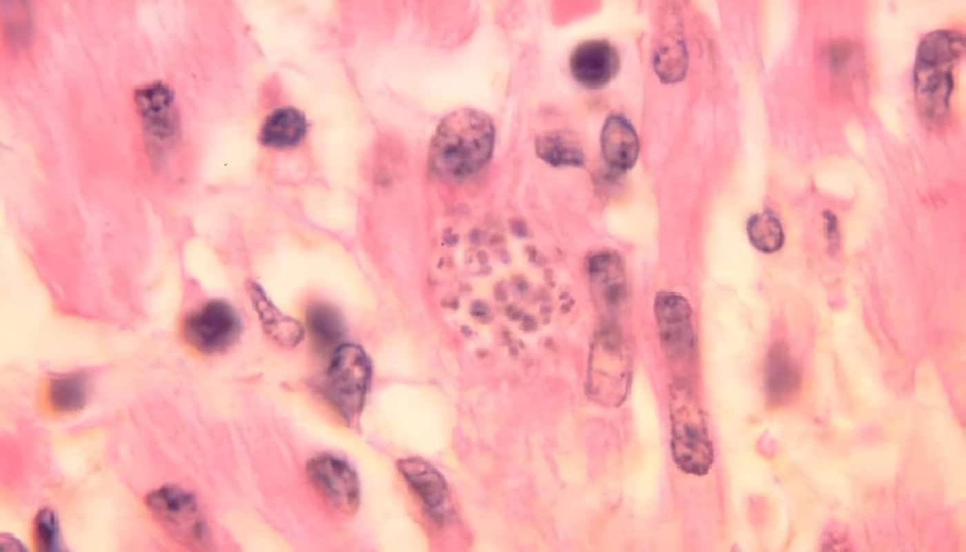 Enfermedad de Chagas