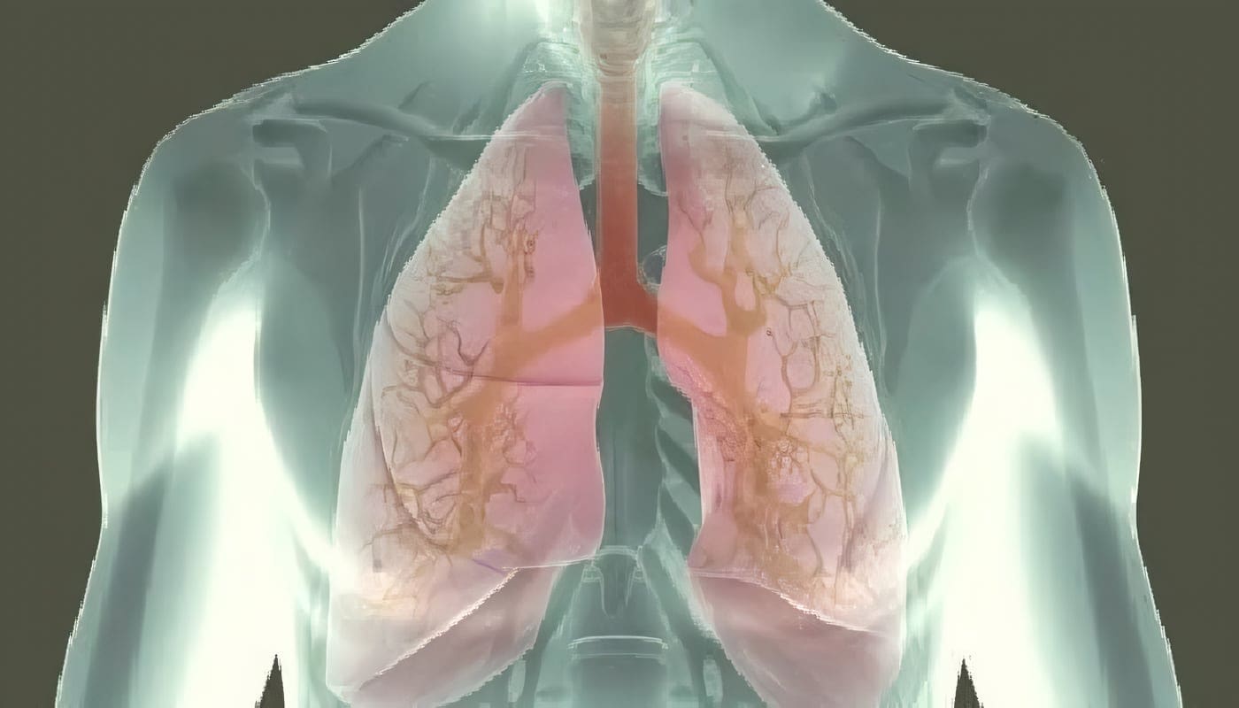 Guía para Tratamiento y rehabilitación de Fibrosis Quística