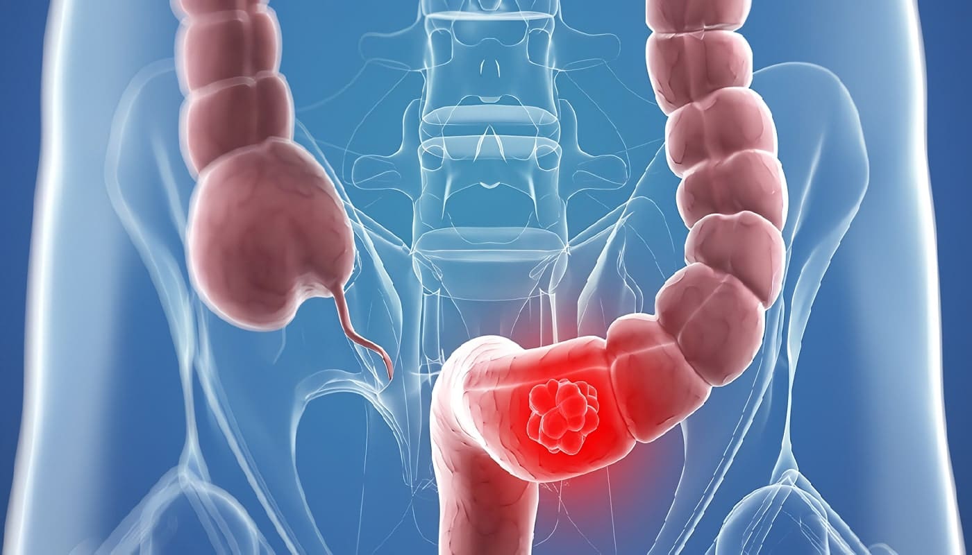 Guía practica Clínica para paciente con Diagnostico de Cáncer de Colon y Recto