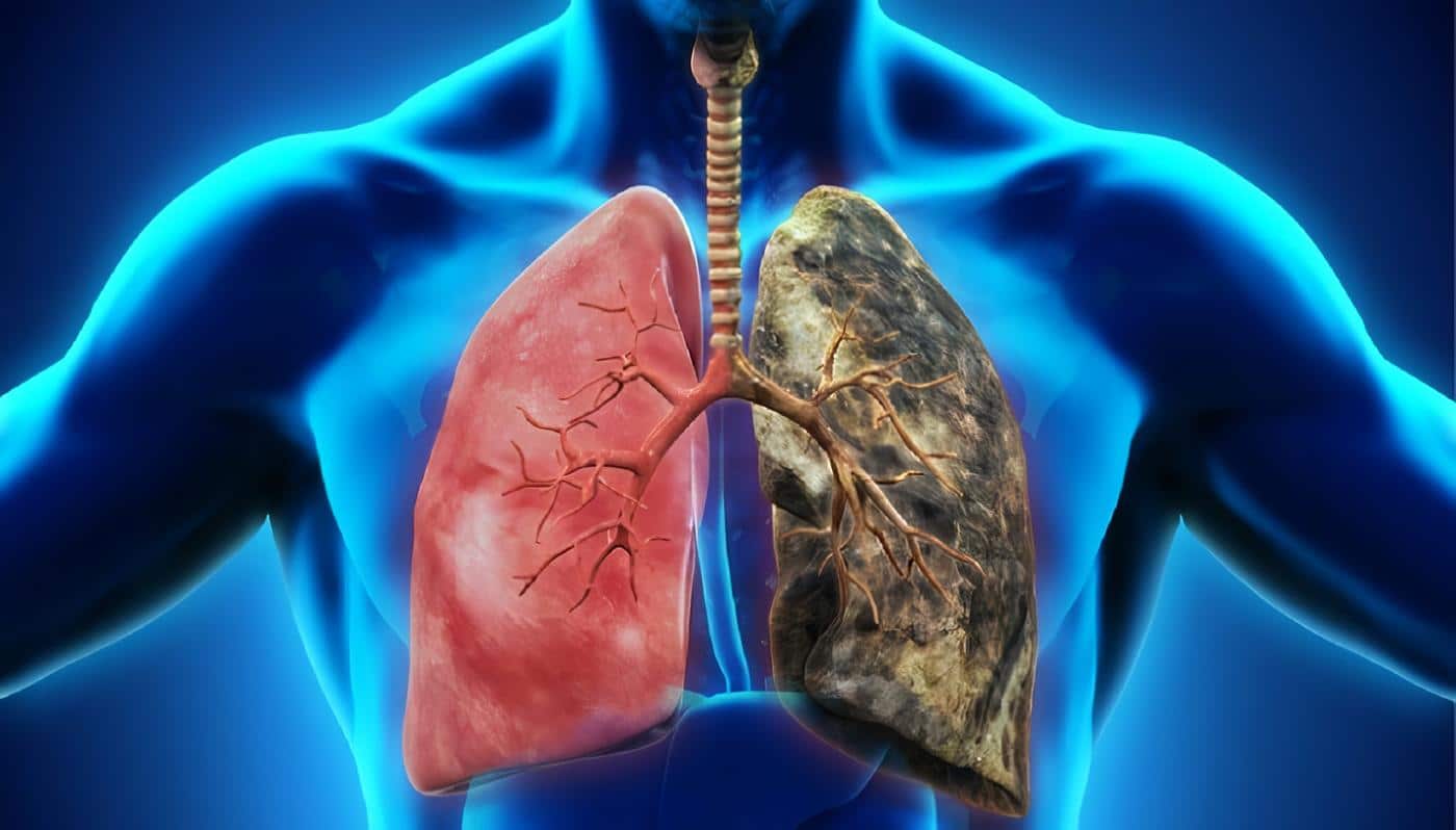 Enfermedad pulmonar obstructiva crónica (EPOC)