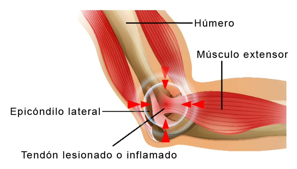 ¿Cómo tratar la Epicondilitis?