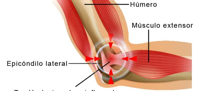 Cómo tratar la epicondilitis