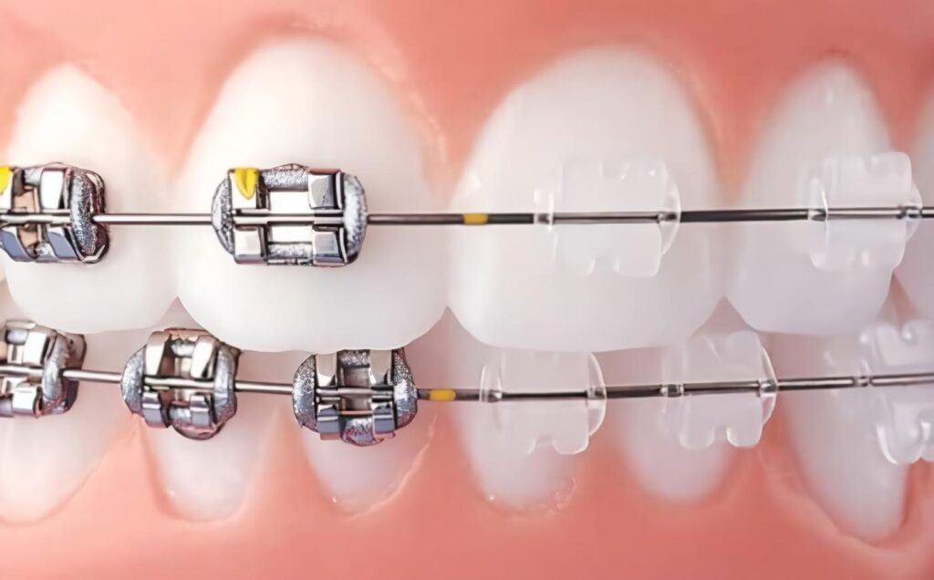 tipos de Brackets