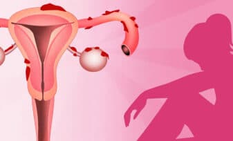 Endometriosis síntomas y tratamientos