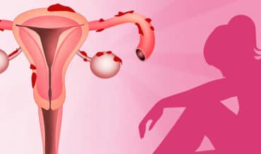 Endometriosis síntomas y tratamientos