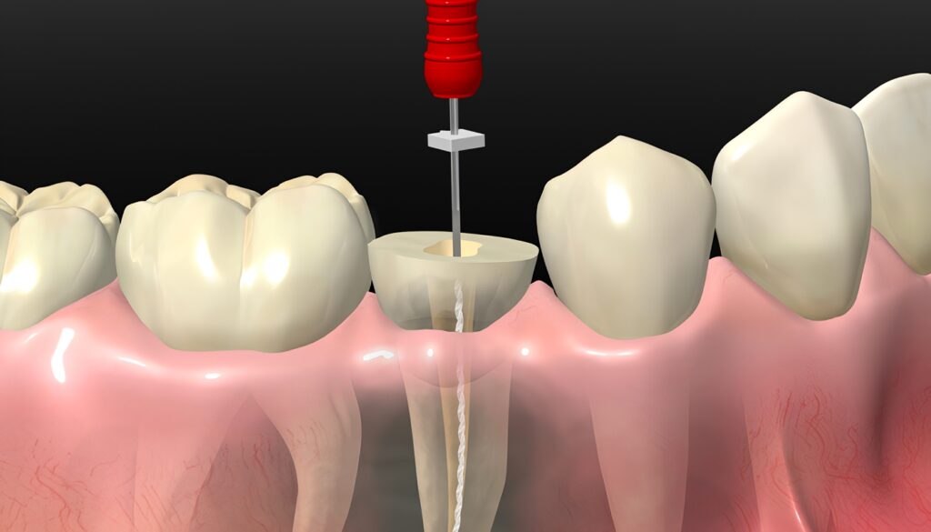 ¿Cuándo es momento de hacerte un Tratamiento de Conducto?