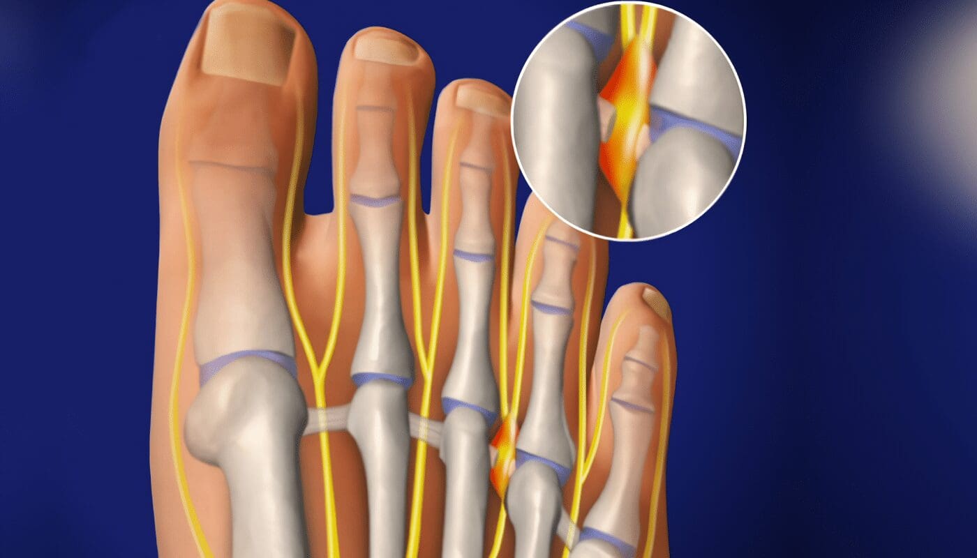 Neuroma de Morton