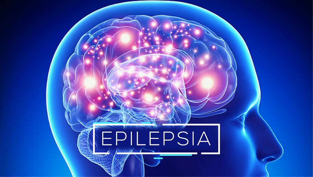 Qué es la Epilepsia