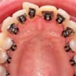 Ortodoncia lingual oculta