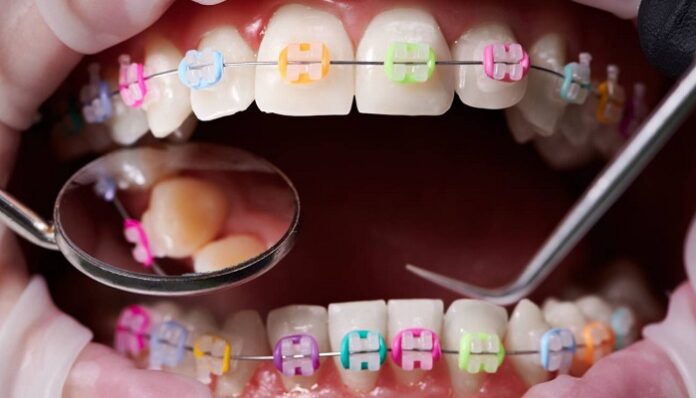 Ortodoncia los mejores tratamientos