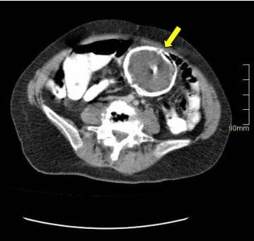 Abdomen que
documenta masa Intraabdominal 