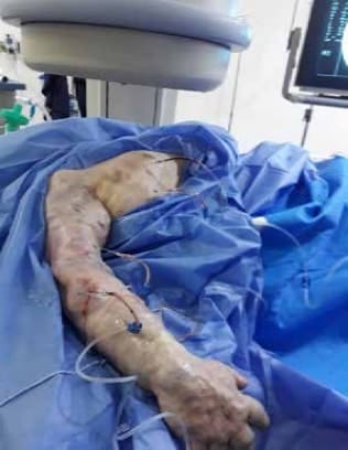 Paciente con múltiples malformaciones en brazo derecho