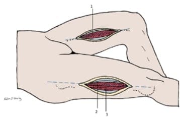 Fasciotomía del muslo
