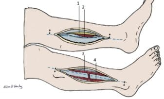 Síndrome Compartimental Agudo - Fasciotomía de la pierna