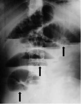 Radiografía simple de abdomen en bipedestación