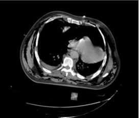 Hemothorax, cardiac herniation to the left pleural - Drenaje Torácico Desafiante