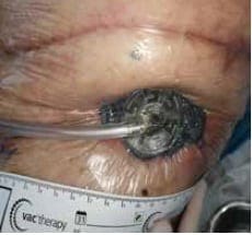 Cicatriz de la
toracotomía posterolateral previa