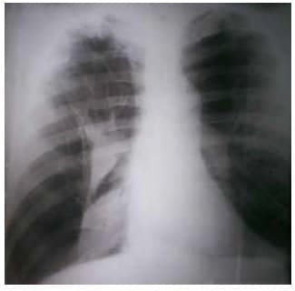 Colapso del pulmón derecho