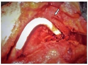 Injerto de Gore-tex implantado entre la carótida primitiva y la carótida interna - Carcinoma del Glomus Carotideo