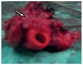 Invasión del tumor a la arteria carótida primitiva